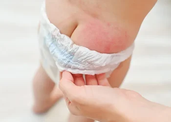 Cara Mengatasi Ruam Popok  pada Bayi yang Perlu Diketahui Ibu